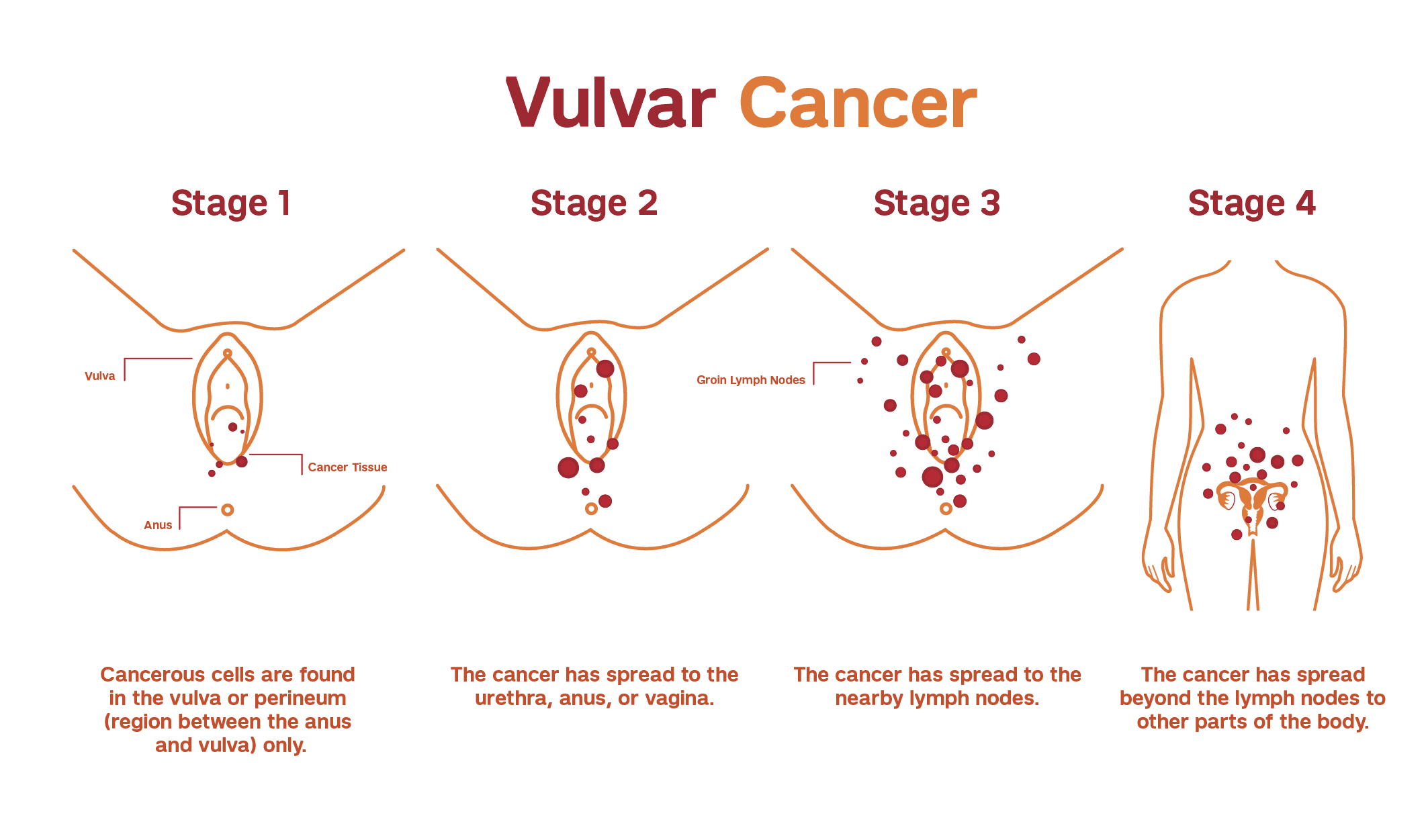 Vulvar Cancer ribbon