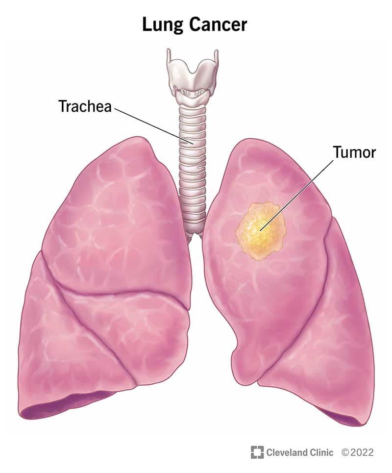 Lung Cancer ribbon