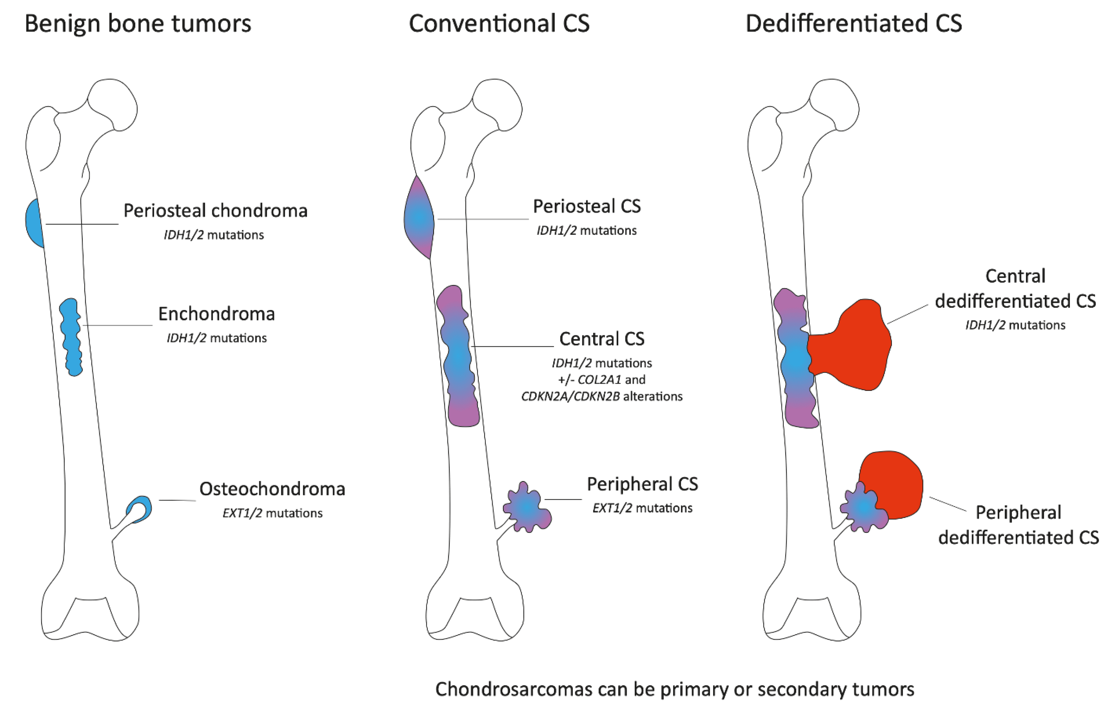 Chondrosarcoma ribbon