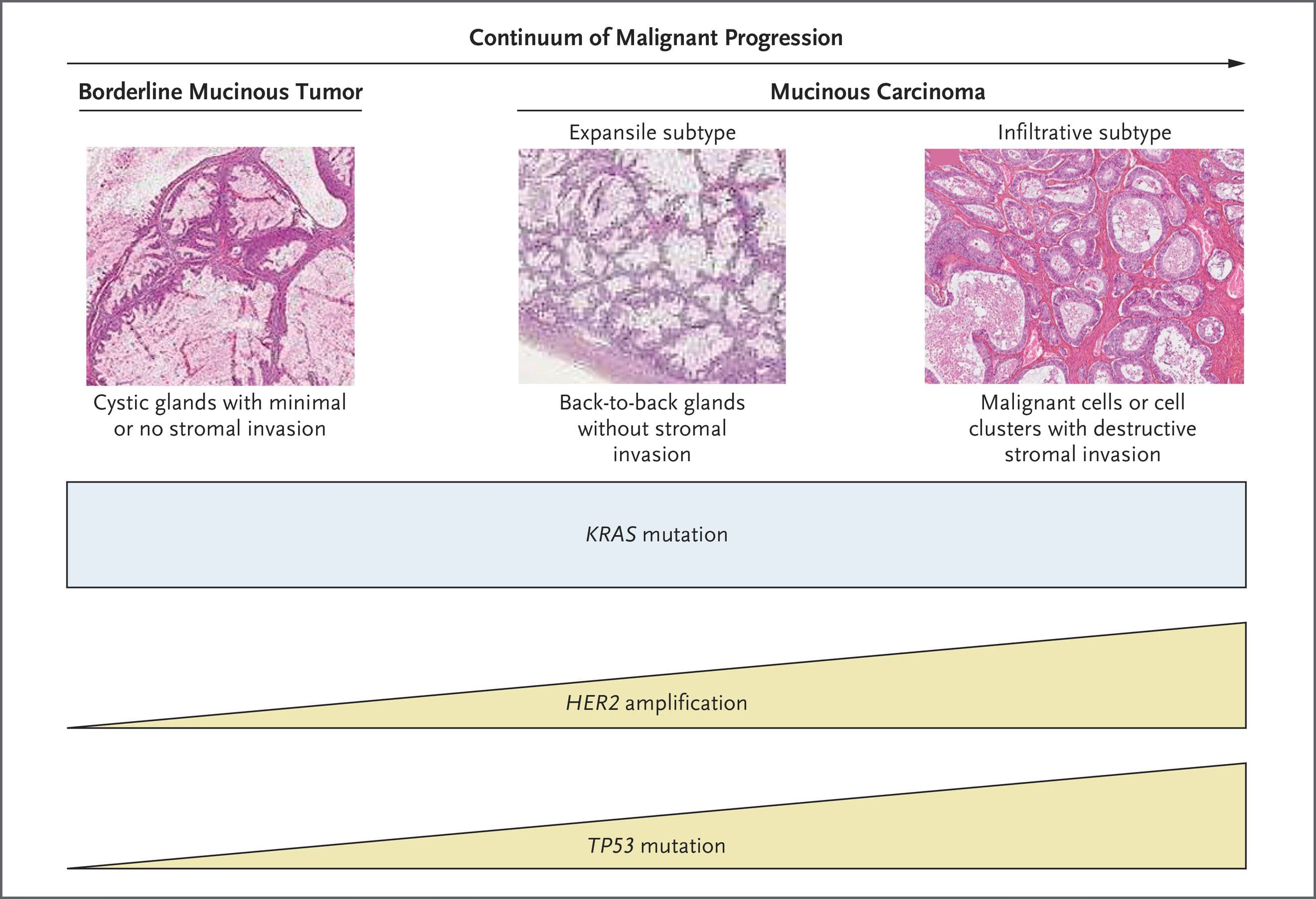 Mucinous Adenocarcinoma ribbon